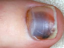 Hematoma under toenail